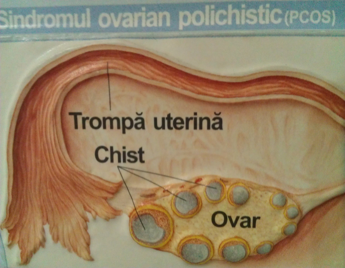 Sindromul de ovar polichistic